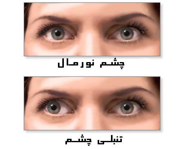 علائم تنبلی چشم