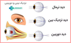 نزدیک بینی و دوربینی چشم